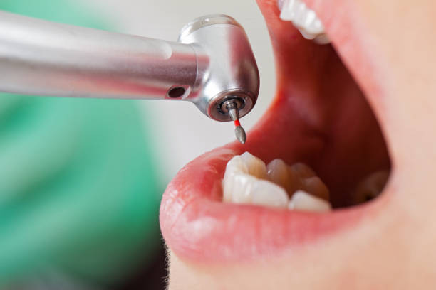 Best Knocked-Out Tooth (Avulsed Tooth) Treatment in East Sandwich, MA